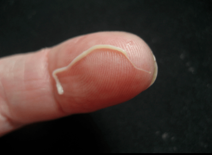 Тегерек курт парази адам денесинен